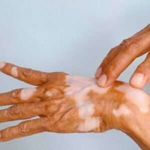 Vitiligo Healing Naturally Webinar