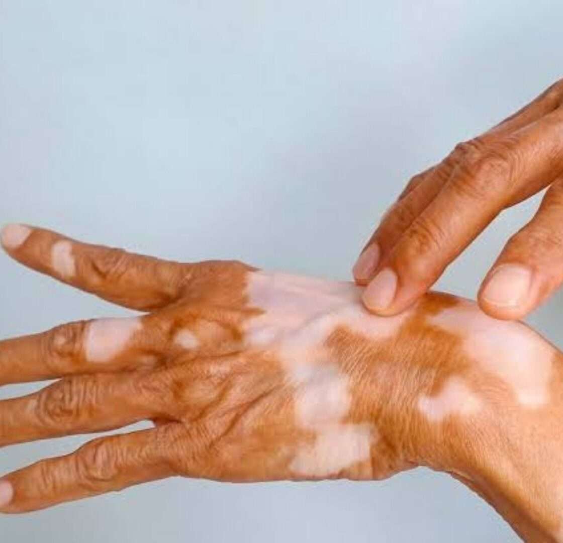 Vitiligo Healing Naturally Webinar