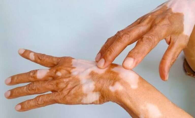 vitiligo-healing-webinar.jpg
