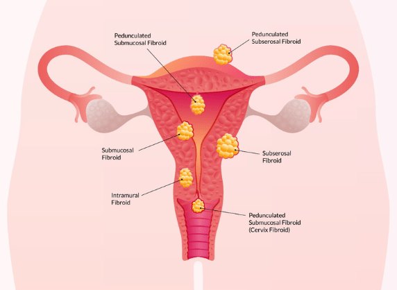 Fibroid Awareness Webinar