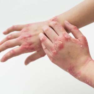 Psoriasis Healing Naturally Webinar