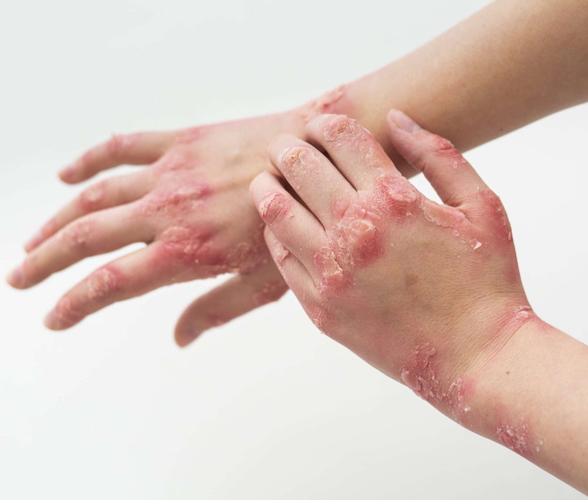 Psoriasis Healing Naturally Webinar