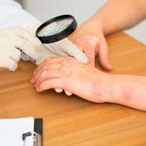Eczema Healing Naturally Webinar
