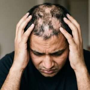 Alopecia & Hair Loss Webinar